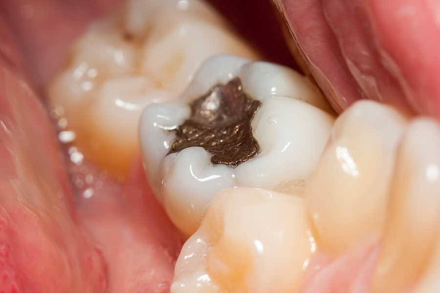 The Aesthetic Advantage: How Cosmetic Fillings Transform Smiles in Sanford, FL