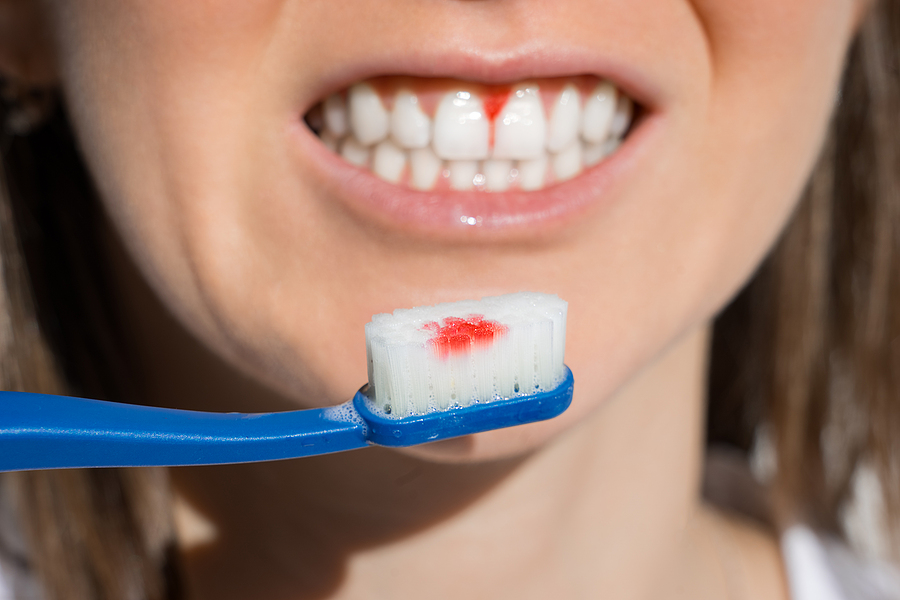 Are Bleeding Gums a Big Concern for Dental Health?